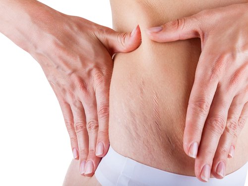 How to Eliminate Stretch Marks during Pregnancy