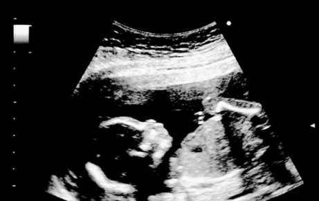 Interesting Facts about the 18th Week of Pregnancy