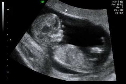 12th Week of Pregnancy