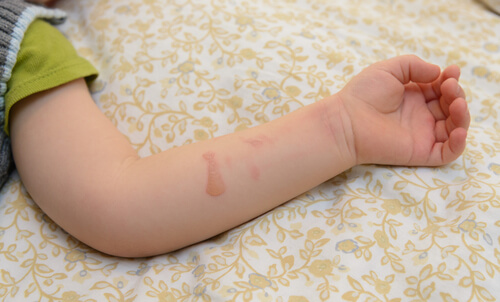 What Should I Do If My Child Has Been Burned with Boiling Water?