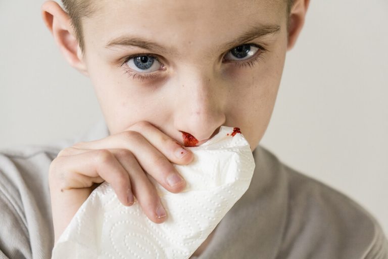 Nosebleeds in Children: Causes and Treatment
