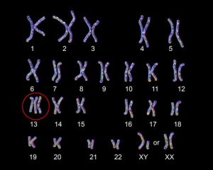 Patau Syndrome In Babies Causes Symptoms And Treatment You Are Mom   Chromosomes 300x240 