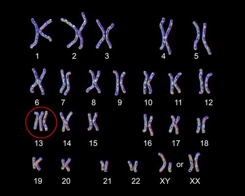 Patau Syndrome in Babies