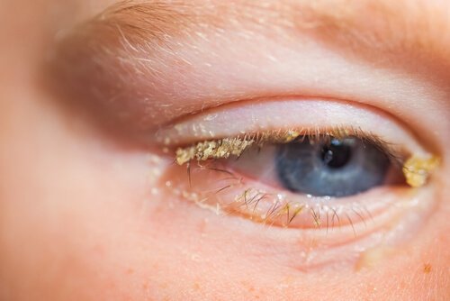 Conjunctivitis in Babies: Causes, Symptoms and Treatment