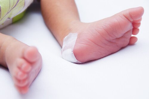 Patau Syndrome in Babies