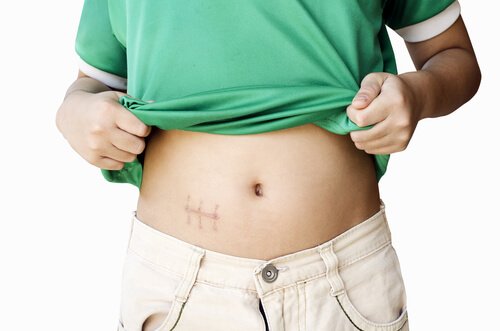 5 Main Symptoms of Appendicitis