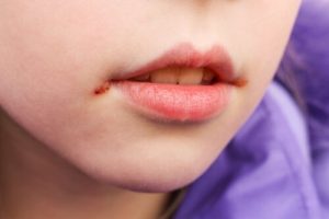 Mouth Sores in Children: Causes and Treatment