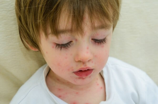 7 Contagious Illnesses in School-Age Children