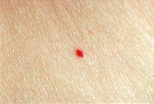 Types of Moles and How to Identify Them