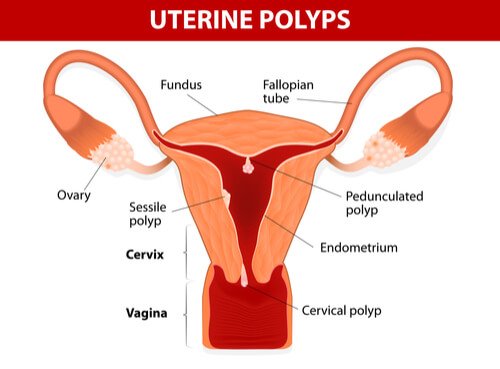 Polyps in the uterus