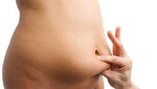 diastasis recti