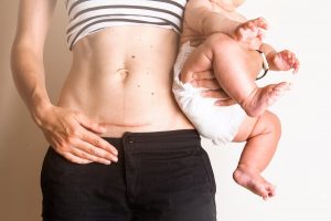 Caring for Postpartum Stitches