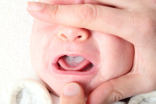 Oral Thrush: Causes, Symptoms, and Prevention
