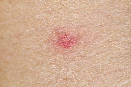 Mark of a wasp sting on skin