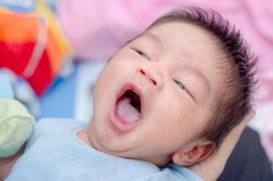 Oral Thrush: Causes, Symptoms, and Prevention
