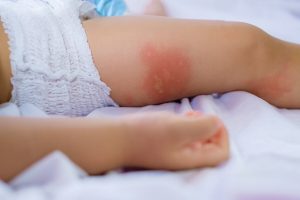 How to Prevent and Treat Diaper Rash
