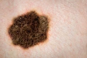 Everything You Need to Know About Moles in Children