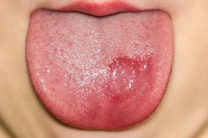 Geographic Tongue in Children: Symptoms and Treatment