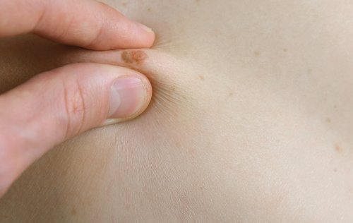 Everything You Need to Know About Moles in Children