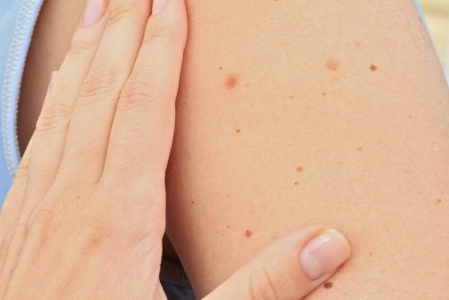 Different Types of Birthmarks in Children