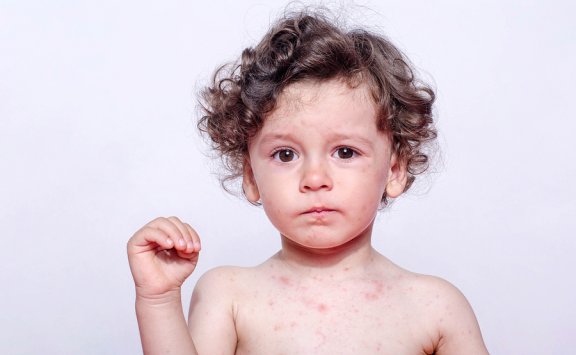 Allergies to Sweat in Children: Symptoms and Treatment