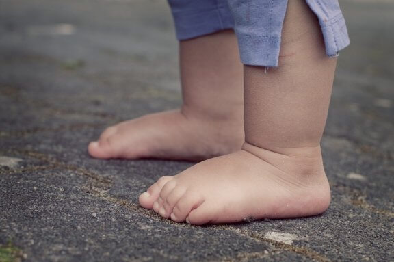 Achondroplasia in Children: Causes and Characteristics