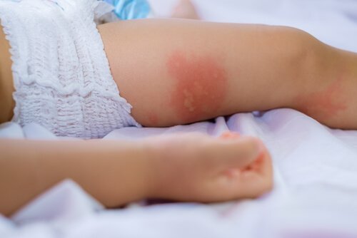 Children's Allergy Tests: What Do They Consist of?