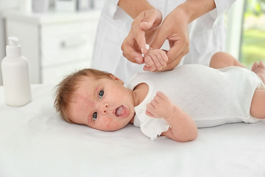 Eczema in Children: How to Prevent Outbreaks
