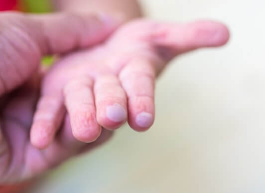 Blisters in Children and How to Treat Them
