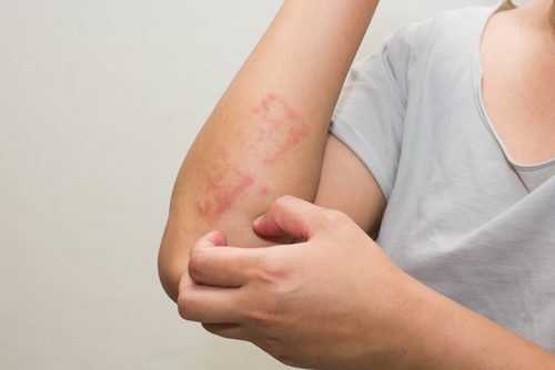 4 Remedies Against Psoriasis for Children