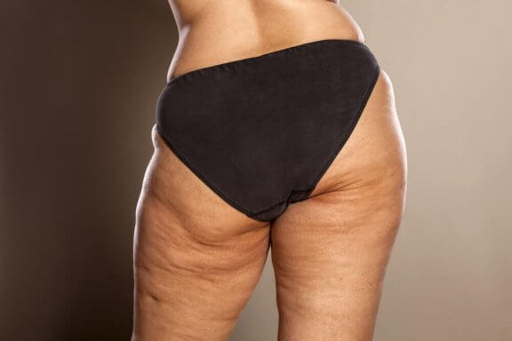 Do You Know How to Fight Cellulite?