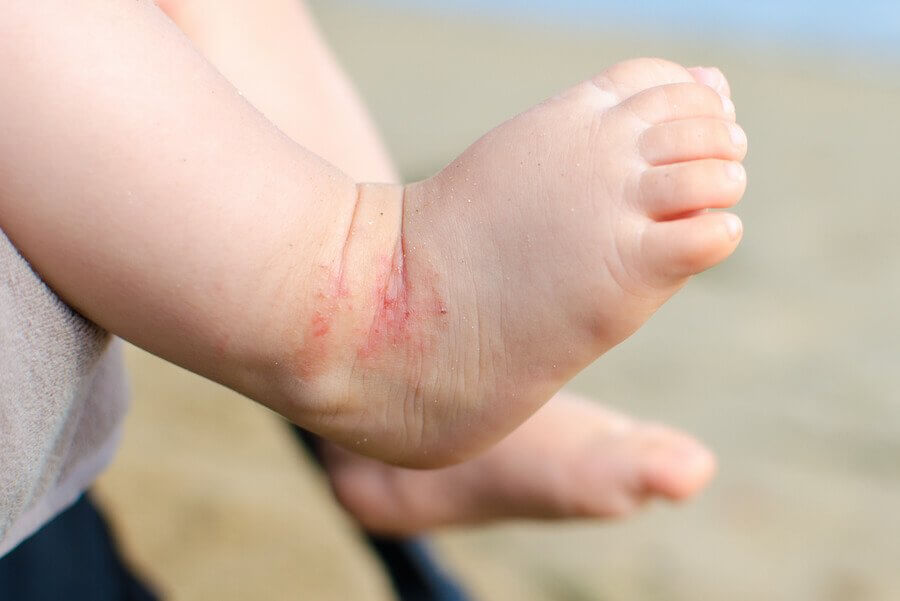 Eczema in Children: How to Prevent Outbreaks