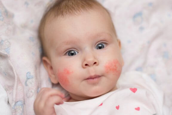 Eczema in Children: How to Prevent Outbreaks
