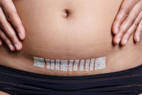 What You Need to Know About Hysterectomies