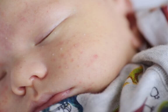 Milia in Newborns: Causes, Symptoms and Treatment