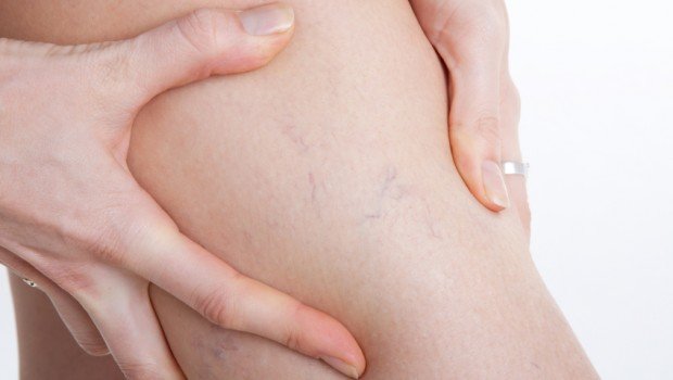 How to Eliminate Varicose Veins During Pregnancy