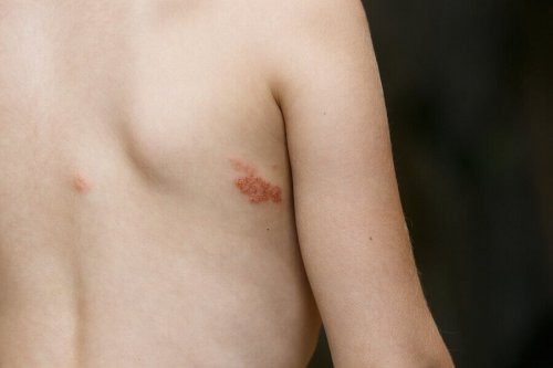 Contagious Impetigo in Children