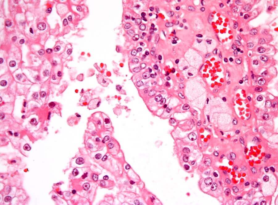 Kidney Cancer in Childhood: Symptoms and Causes