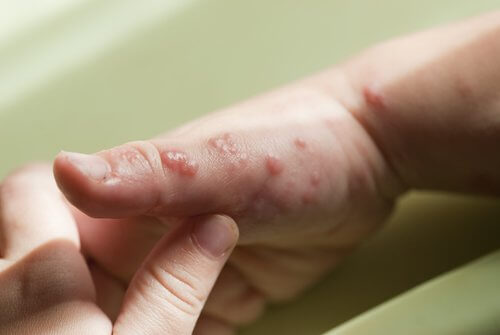 How to Cure the Blisters Caused by Herpes