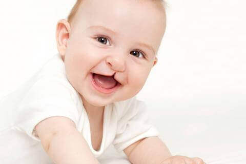 Common Craniofacial Anomalies in Babies