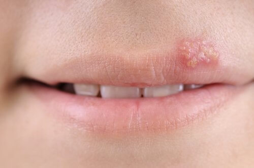 How to Cure the Blisters Caused by Herpes