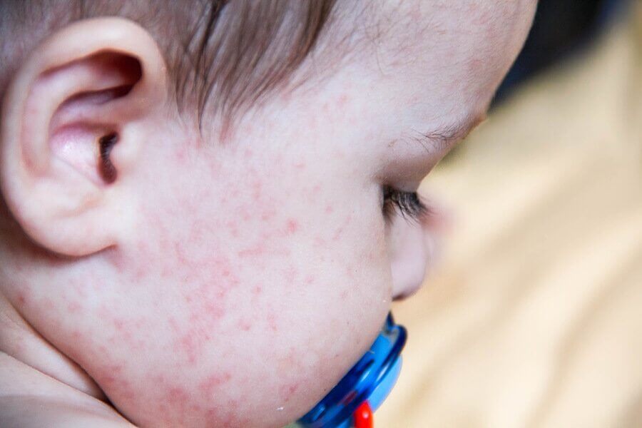 10 Most Common Skin Conditions in Babies