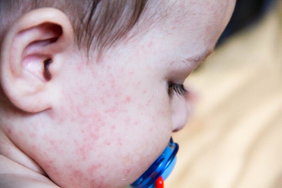Exanthematous Diseases in Children - You are Mom