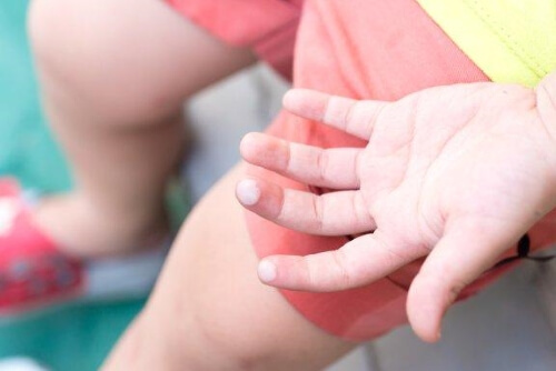 How to Treat Blisters in Children