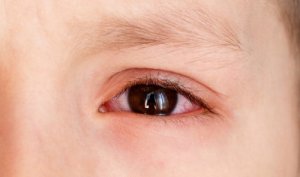 Causes of Choroidal Effusions in Children