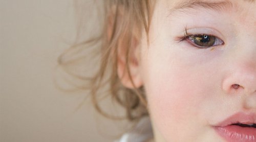 Conjunctivitis in Babies: How to Treat It