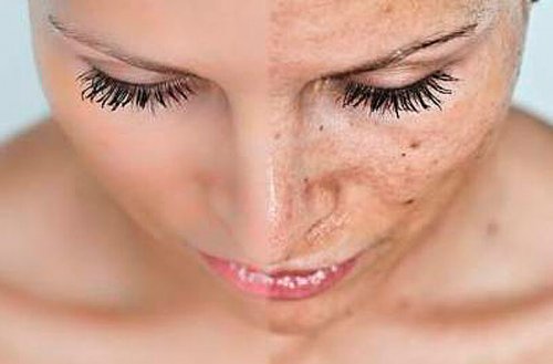 Dark Dry Patches On Skin During Pregnancy