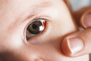 What Are the Red Spots on My Baby's Eyes?