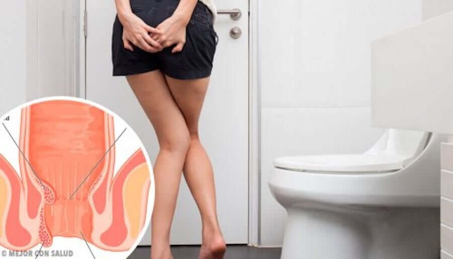 The Treatment of Internal Hemorrhoids