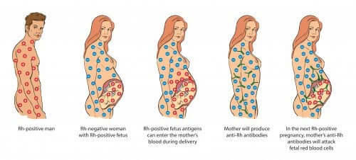 Rh Incompatibility During Pregnancy: What You Need to Know